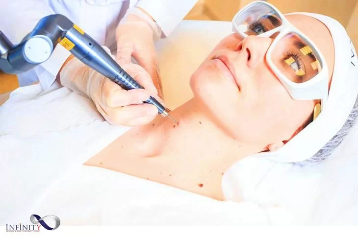 Лазерно премахване на бенки и папиломи | Infinity Clinic.